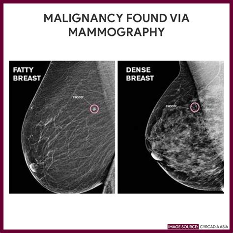 mammography biweekely compression test|mammogram results for cancer patients.